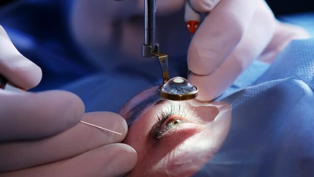 Cataract Surgery: What You Need to Know